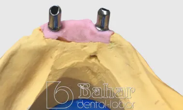 Teleskop Protez - İstanbul Diş Laboratuvarı