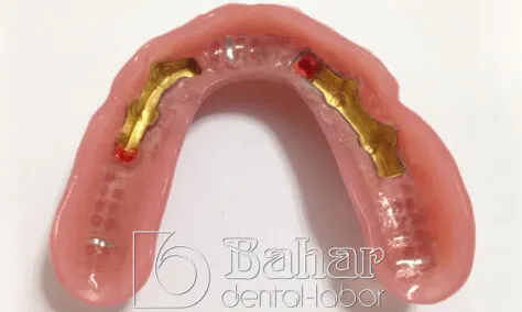 Galvano Altın Kaplama - diş laboratuvari