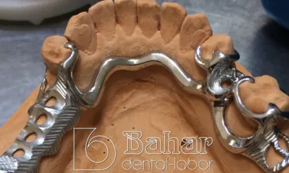 İskelet Protez imalatı istanbul