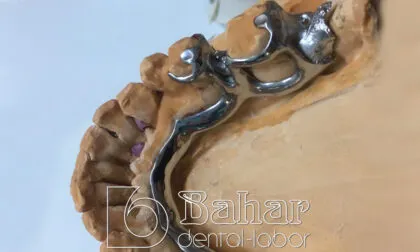 İskelet Protez istanbul diş protezleri