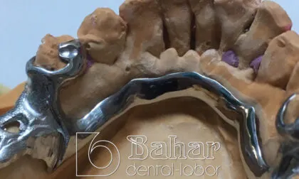 İskelet Protez - diş laboratuvarı