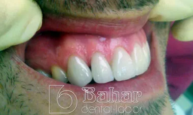 Lamine Diş Kaplama Bahar Dental