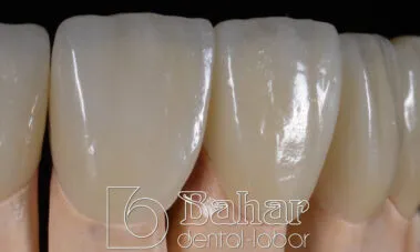 Lamine diş kaplama - diş laboratuvarı