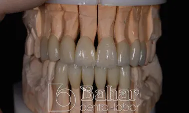 lamine diş kaplama - diş laboratuvarı