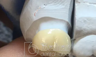 Multilayer Zirkonyum Diş Kaplama istanbul