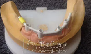 Barlı Protez (CAD/CAM) İmalatı