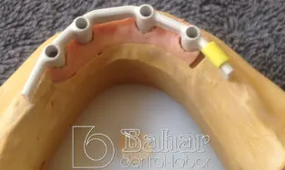 Barlı Protez (CAD/CAM) hibrit protezler