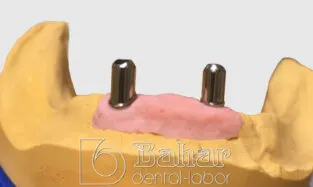 Barlı Protez (CAD/CAM) Üretimi