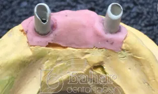 Barlı Protez (CAD/CAM) Дфищкфегмфкэ