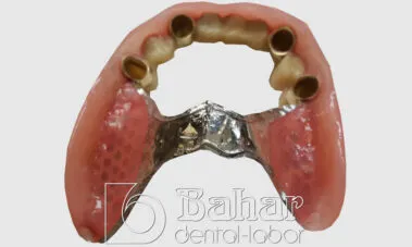 Teleskop Protez - İstanbul Diş Laboratuvarı