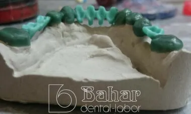 Teleskop Protez - İstanbul Diş Protezleri