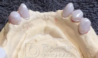 Teleskop Protez - İstanbul Bahar Dental