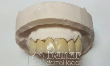 Teleskop Protez - İstanbul Bahar Dental