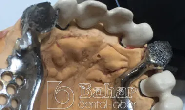 Teleskop Protez - İstanbul Bahar Dental