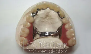 Teleskop Protez - İstanbul Diş Protezleri