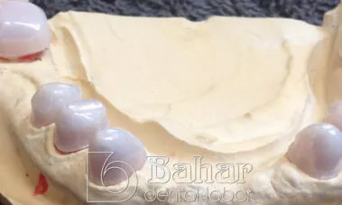 Teleskop Protez - İstanbul Diş Protezleri