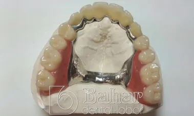 Teleskop Protez - İstanbul Diş Protezleri