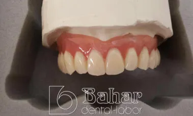 Teleskop Protez - İstanbul Bahar Dental