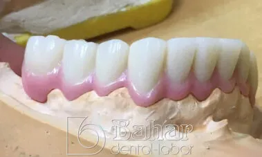 Teleskop Protez - İstanbul Bahar Dental