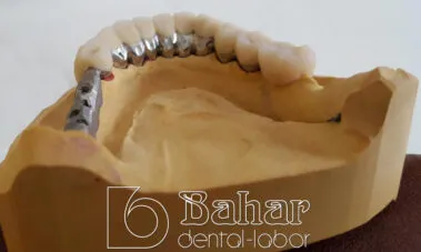 Teleskop Protez - İstanbul Bahar Dental