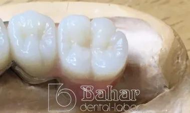 Teleskop Protez - İstanbul Bahar Dental