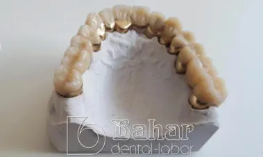 Teleskop Protez - İstanbul Bahar Dental
