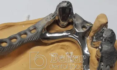 Teleskop Protez - İstanbul Bahar Dental