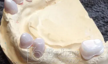 Teleskop Protez - İstanbul Diş Laboratuvarı