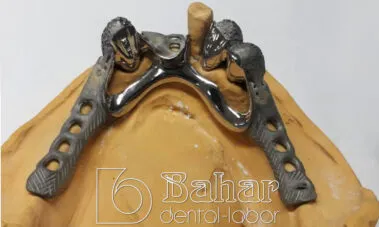 Teleskop Protez - İstanbul Diş Laboratuvarı