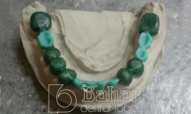 İstanbul Diş Protez üretimi