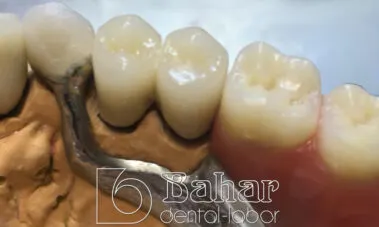 Teleskop Protez - İstanbul Diş Laboratuvarı