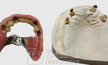 İstanbul Diş Protez üretimi