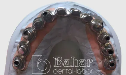 Toronto Bridge (CAD/CAM) diş protezleri