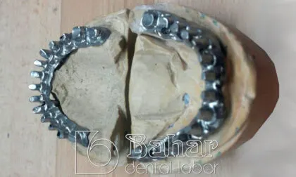 diş laboratuvarı diş protezleri