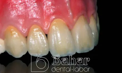 Toronto Bridge (CAD/CAM) diş laboratuvarı