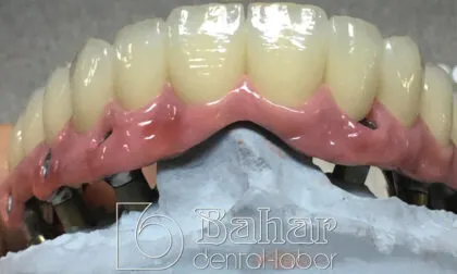 Toronto Bridge (CAD/CAM) diş protezleri istanbul