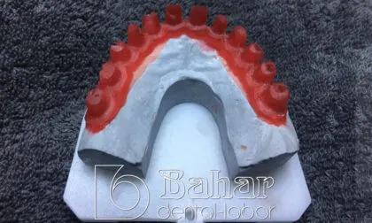 Toronto Bridge (CAD/CAM) diş protezleri istanbul