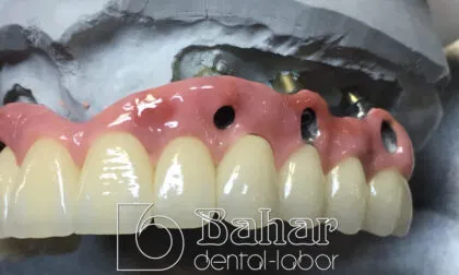 Toronto Bridge (CAD/CAM) bahar dental