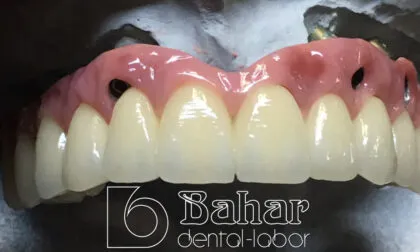 Toronto Bridge (CAD/CAM) istanbul diş laboratuvarı