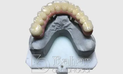 Toronto Bridge (CAD/CAM) protez imalatı