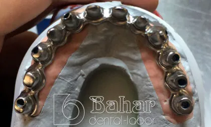 Toronto Bridge (CAD/CAM) diş protezleri