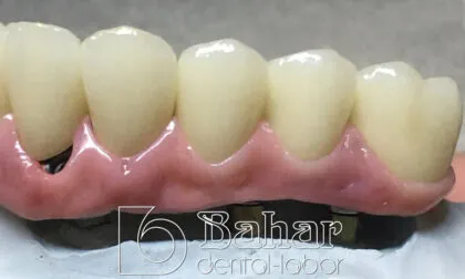 Toronto Bridge (CAD/CAM) istanbul