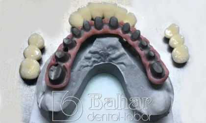 Toronto Bridge (CAD/CAM) diş protezi