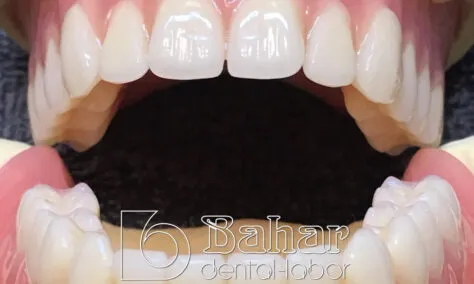 Total Protez (CAD/CAM)