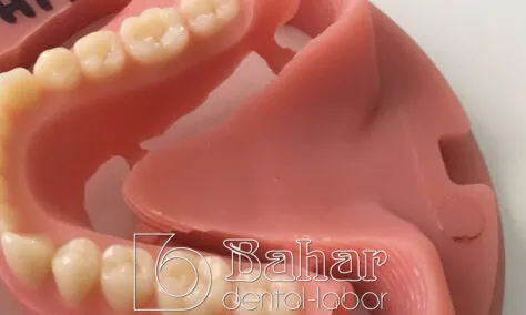 Total Protez (CAD/CAM)